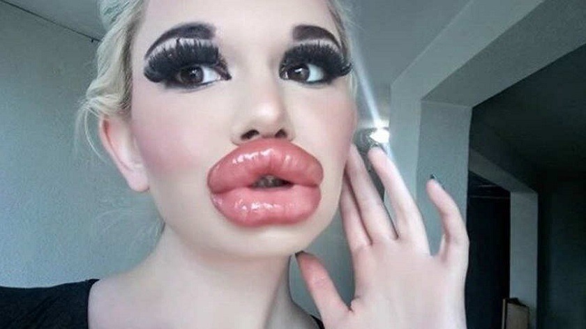 ¿Por el récord?, la “Barbie humana” se operó los labios de nuevo