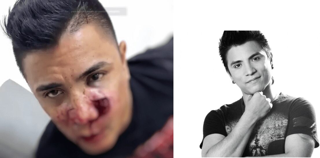 Así quedó el rostro del actor Mauricio Bastidas tras recibir un disparo en medio de atraco
