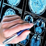 prevenir el Alzheimer
