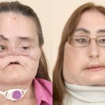 trasplante facial