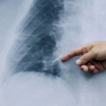 Revelan el daño que le hace un diagnóstico tardío a los pacientes con cáncer de pulmón