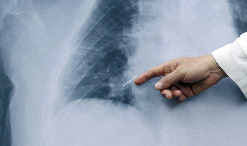 Revelan el daño que le hace un diagnóstico tardío a los pacientes con cáncer de pulmón