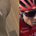 Nairo Quintana, operado de ambas rodillas en un hospital de Lyon