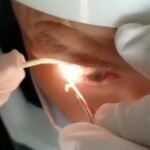 Sacan 20 gusanos vivos del ojo de un hombre conocido como Sr. Wan
