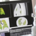 Los problemas pulmonares que podría ocasionar la COVID meses después de contagiarse