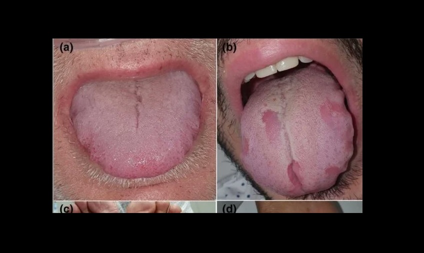 Alteraciones en la lengua y en manos y pies son nuevos síntomas de COVID-19