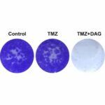 Hallan terapia que mejoraría la supervivencia de pacientes con tumor cerebral (1)