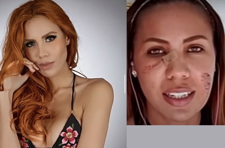 María del Mar Meza, la Miss Bogotá a la que un dron le dañó la cara