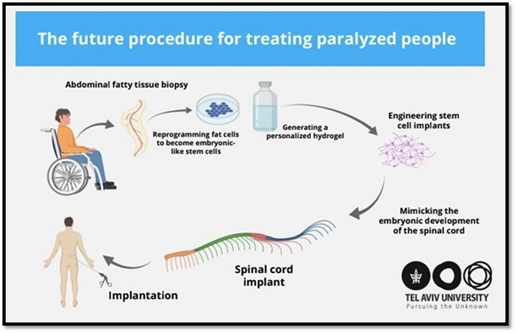 Un estudio israelí busca revertir la parálisis con implantes de médula espinal