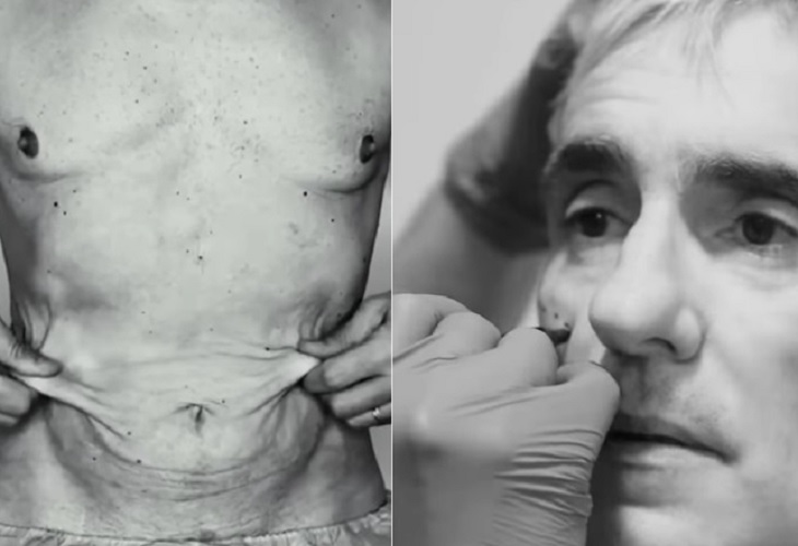 Miguel Varoni mostró cómo le quitaron toda la piel que le sobraba en el abdomen