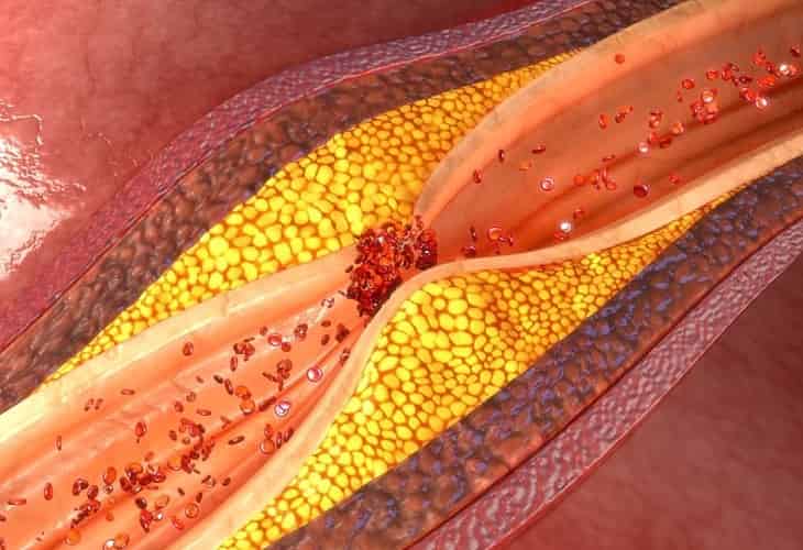 Descubren una proteína que previene el desarrollo de placas en las arterias