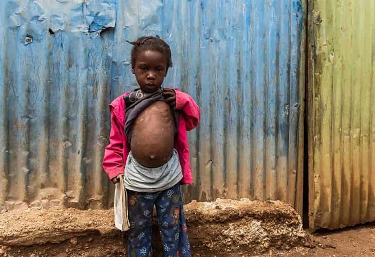 Una contagiosa enfermedad cutánea hace estragos en zonas rurales de Haití