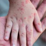 La OMS no cree que la viruela del mono se convierta en otra pandemia