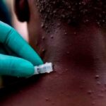 Nigeria confirma la primera muerte por viruela del mono durante 2022