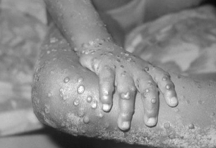 Detectan varios casos de la viruela del simio en Madrid, España