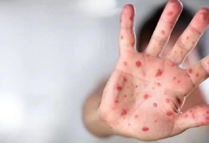 OMS decide que viruela del mono no es una emergencia sanitaria internacional