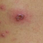 Fallece el primer caso de viruela del mono detectado en Cuba