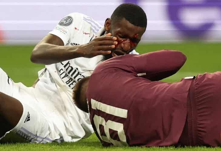 Rüdiger no sufre lesión ósea y no está descartado para el clásico