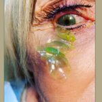 Sacan 23 lentes de contacto del ojo de una paciente que olvidó quitárselos