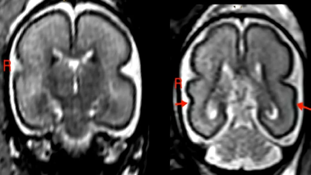 Beber en el embarazo, incluso poco, produce cambios en el cerebro del bebé
