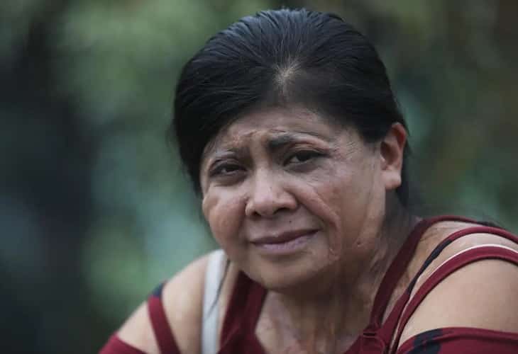 Cambio de piel - la transformación de las sobrevivientes de ataques con ácido