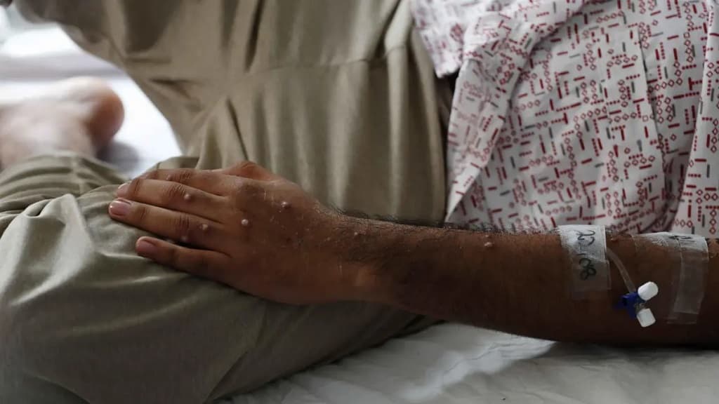 Las mujeres transexuales, altamente vulnerables ante la viruela del mono