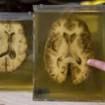 Una nueva terapia abre la puerta a tratar la epilepsia y otros trastornos