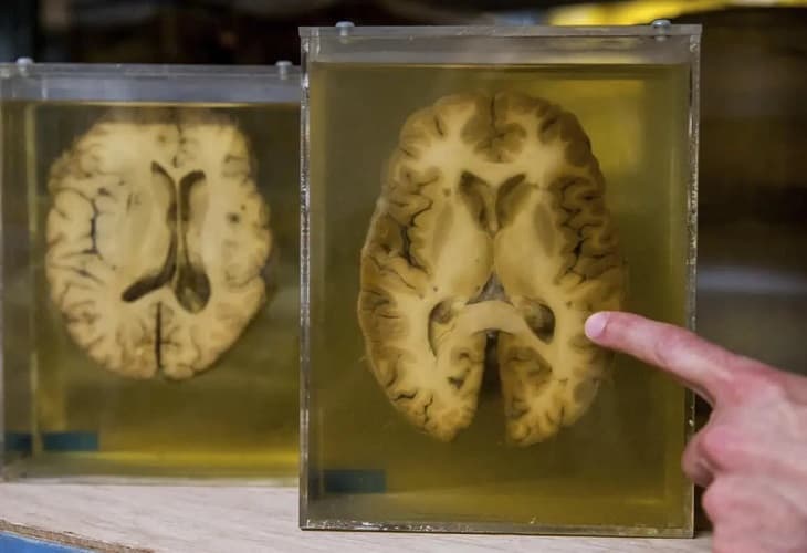 Una nueva terapia abre la puerta a tratar la epilepsia y otros trastornos