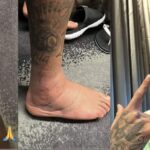 Fotos del tobillo lesionado de Neymar jr