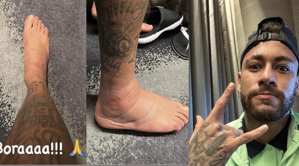 Fotos del tobillo lesionado de Neymar jr