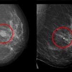 Cáncer de mama - nuevo método para buscar el mejor fármaco para cada paciente