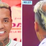 Dayro Moreno se está quedando calvo