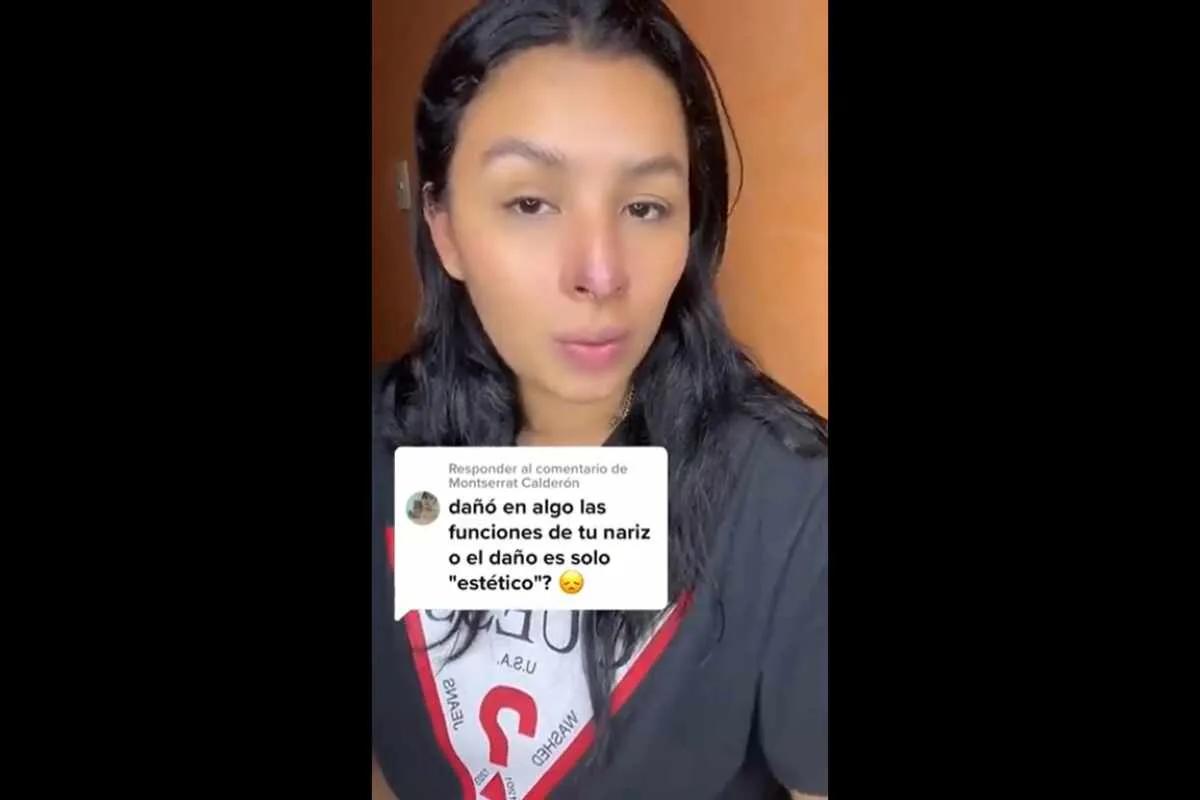 Nadia Ortiz : Inyección de ácido hialurónico causa necrosis en la nariz de una mujer