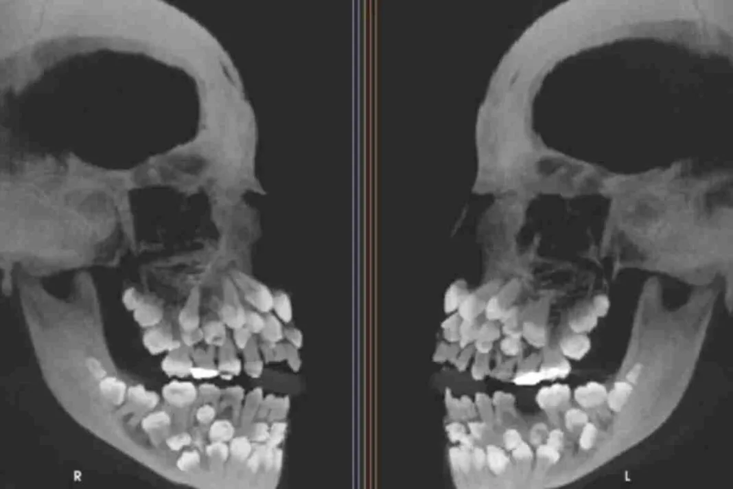 Niña de 11 años tiene 81 dientes - Un caso inusual de hiperdoncia múltiple