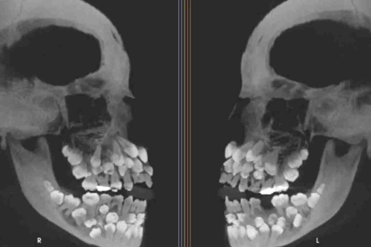 Niña de 11 años tiene 81 dientes: Un caso inusual de hiperdoncia múltiple