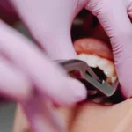 Dentista revela los 4 errores comunes que dañan los dientes