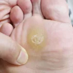 Cómo eliminar los callos en los pies: 5 consejos prácticos y seguros