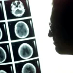 Identifican 4.000 variantes genéticas relacionadas con la estructura del cerebro
