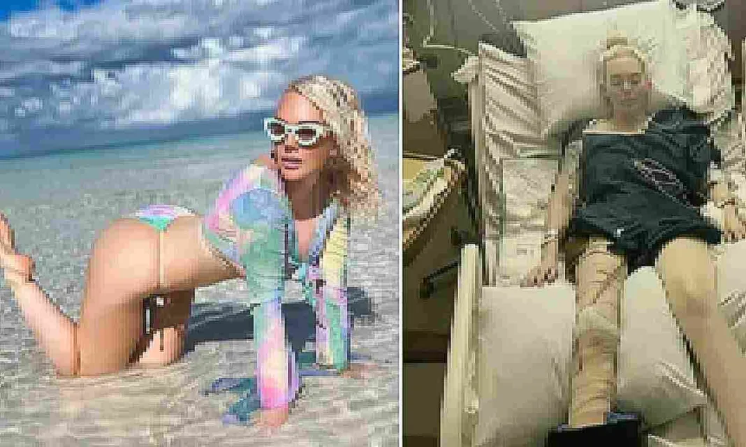 Modelo de Georgia pierde una pierna por bacteria carnívora en sus vacaciones en las Bahamas