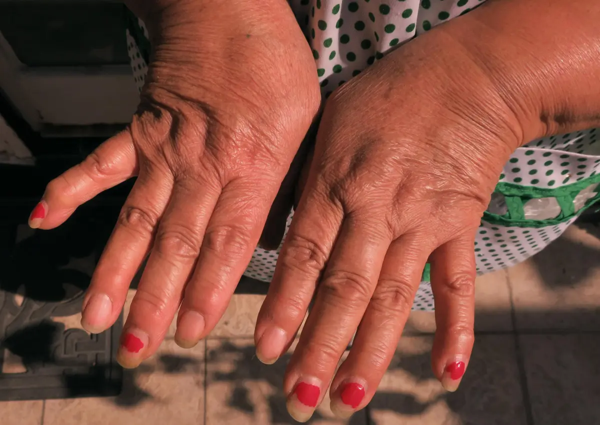 Mil millones de personas sufrirán osteoartritis en 2050, según un estudio