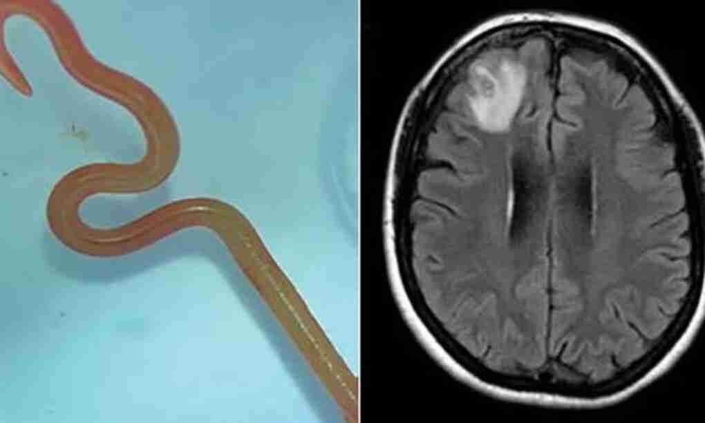 Neurocirujano extrae gusano de 8 cm del cerebro de una paciente en Australia