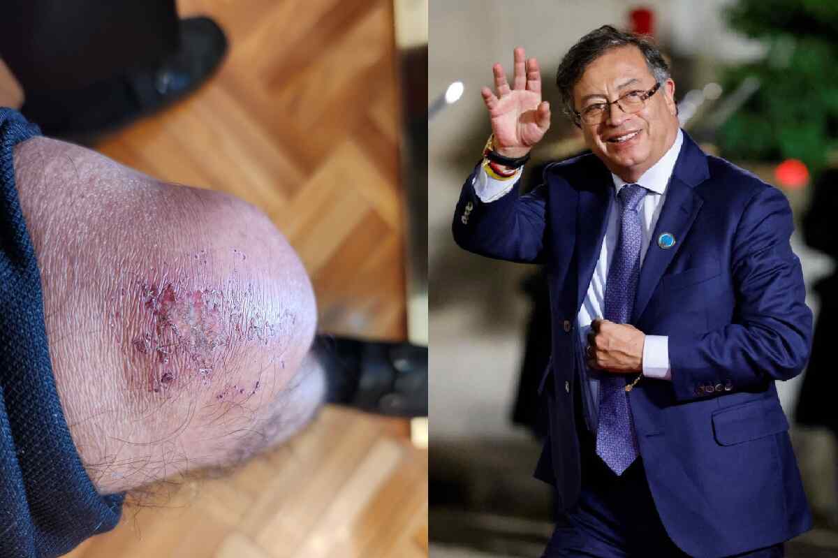 Foto de la caída de Gustavo Petro que le dejó una rodilla dolida en Cartagena