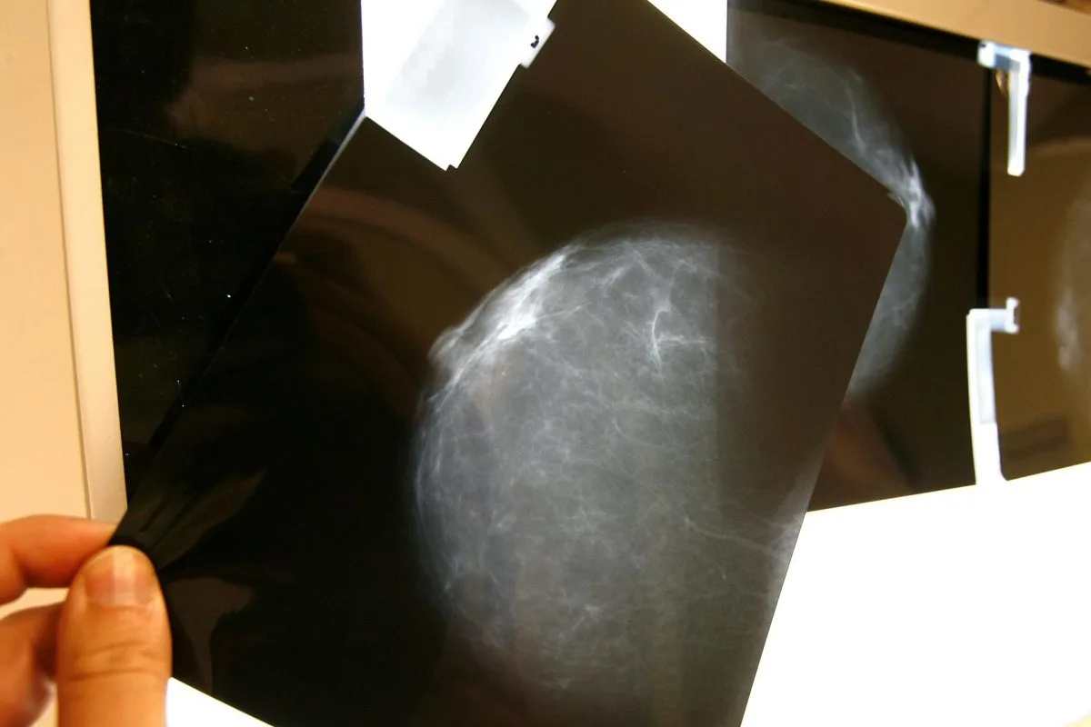 Descifran el mecanismo de una proteína clave en la metástasis de cáncer de mama