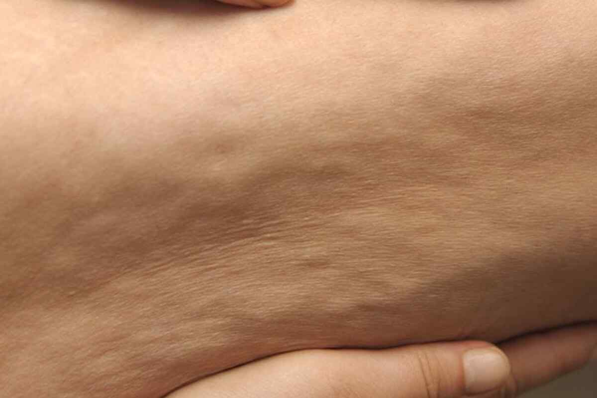 Cómo mejorar el aspecto de tu piel con la alimentación: alimentos y ejercicios para combatir la celulitis