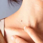 Cómo reconocer los signos de la leucemia y qué hacer para prevenirla
