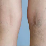 Descubre las Causas de las Várices y Cómo Prevenirlas: Guía Completa