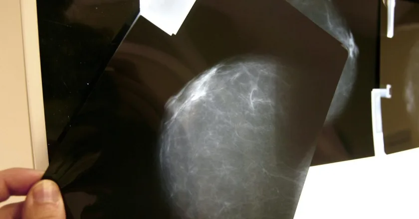 Un informe denuncia la inacción que ha “dejado atrás” pacientes con cáncer de pecho
