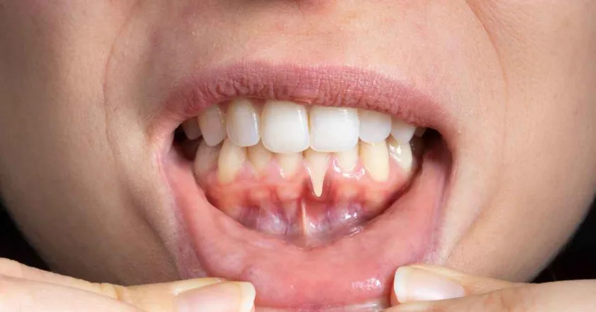 Remedios naturales contra encías retraídas: Una guía completa para tu bienestar dental