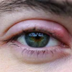 Orzuelos-como prevenirlos y tratarlos si aparecen