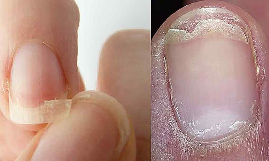 6 señales en las uñas que te alertan de problemas de salud y cómo prevenirlas